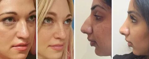 Rhinoplasty before and after Uk, Wide Nose, Bulbous Rounded 