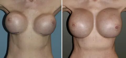 Sagging Breasts Surgery View Plastic Surgery Clinic - Fotoim