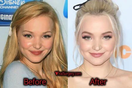 Dove Cameron Plastic Surgery Nose Job, Before After Pictures