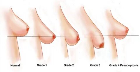 Breast lift Tunisia : Mastopexy cost Tunisia 