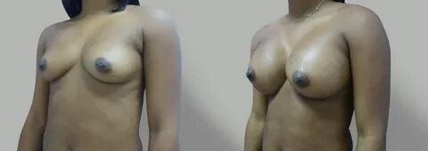 NYC Midtown Breast Implants Before and After Pictures Long I