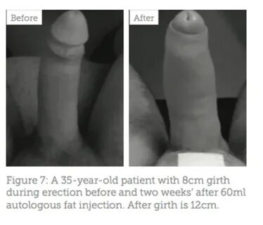 Penile Augmentation - Aesthetics