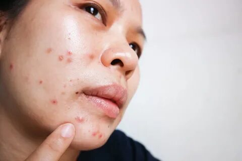 Parents should help their children fight acne - South Africa