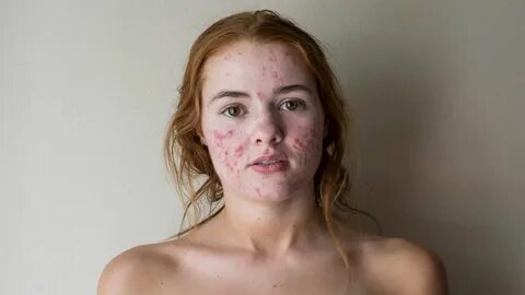 Natural Ways to Cure Acne - YouTube