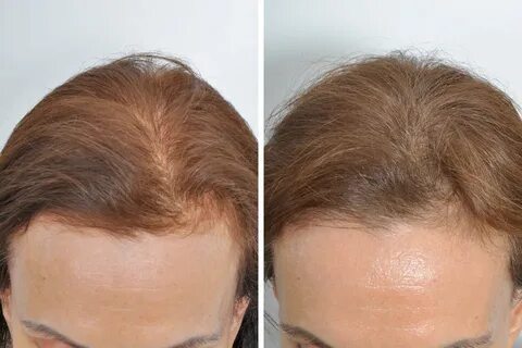 Hair Loss Treatments (Surgical) For Women - Dr. David Rosenb