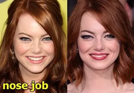 Emma stone plastic surgery - Plastic Surgery