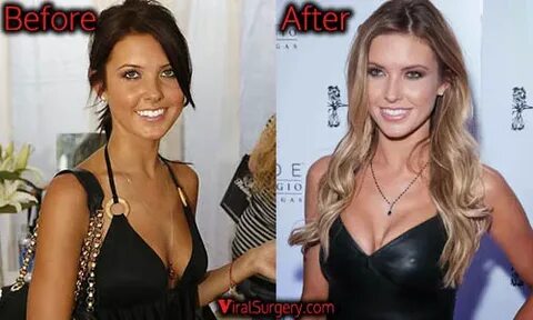 Audrina Patridge Plastic Surgery: Boob Job, Nose Job Before 