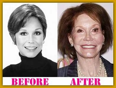 Mary Tyler Moore plastic surgery turned to the worse. Bad ce