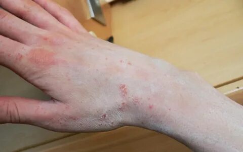 natural-treatments-for-scabies BlogLino