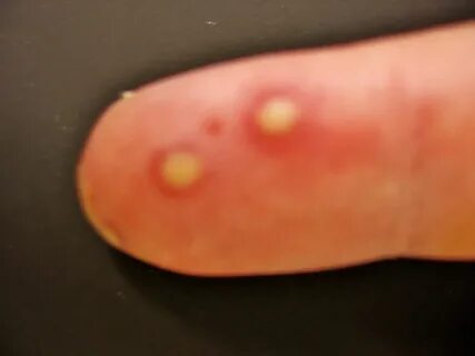 Herpes Virus Gives Man a Blistery Finger Infection Live Scie