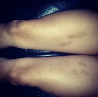Sex bruises on legs â™¥ Leg Bruise