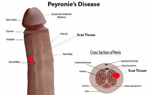 Peyronies disease porn