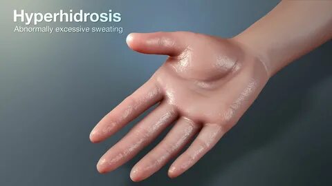 Excessive Sweating (hyperhidrosis)