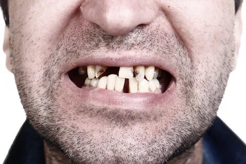 Wissenschaft: Aspirin kann den Zahnverfall umkehren und Zähn