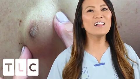 "It Kind Of Looked Like A Plum Coming Out" Dr Pimple Popper:
