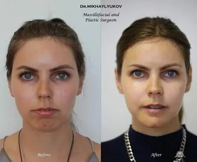 Ортогнатическая хирургия. Фотографии "до и после". ⋆ Хирург 