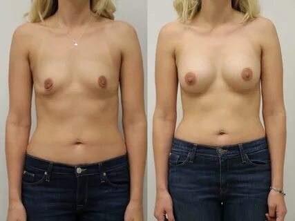 Before & After Breast Augmentation Case 51 View #1 View in Gilbert, AZ.