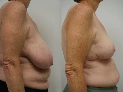 Before & After Breast Reduction Case 106 View #2 View in Gilbert, AZ.