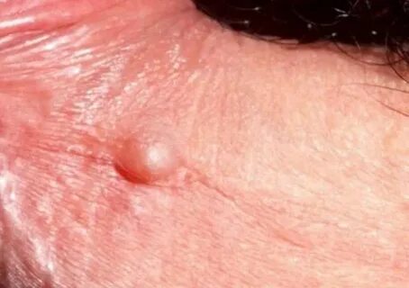 Pimple on penis causes, symptoms, treatment & pictures