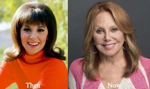 Marlo Thomas Plastic Surgery Before and After Photos - Lates