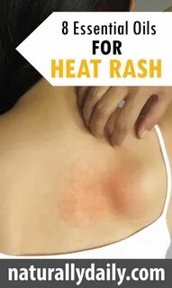 7 Best Essential Oils for Heat Rash: Causes & Remedies Heat rash, Best ...