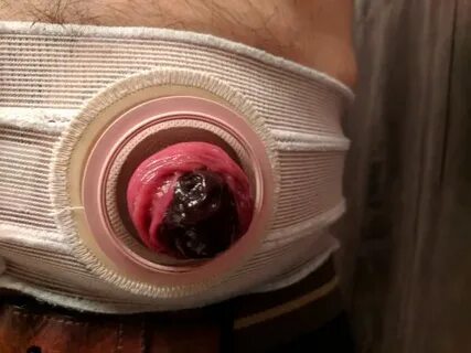 Partial Black Stoma - Ostomy Forum Discussions