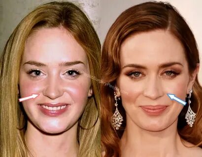 Did Emily Blunt Have Plastic Surgery? (Before & After 2022)