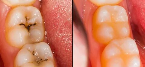 Die richtige Füllung für jeden Zahn - Zahnarzt