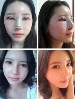 South Korea Tops Plastic Surgery Tables Again FACT, INFORMAT