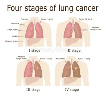 Lung cancer sex diference in stage distribution