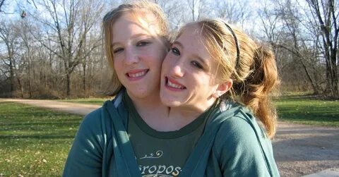 What Conjoined Twins Abby And Brittany Hensel Look Like Toda