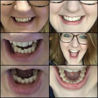 Reviews And Results - SmileDirectClub Smiledirectclub, Denta