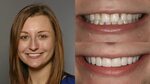 Before & After Composite Veneers Treatment 8