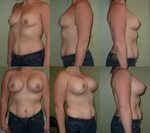 High Profile Silicone Gel Breast Implants Before & After Pho