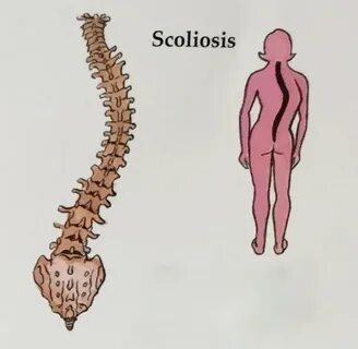 Scoliosis paintings search result at PaintingValley.com