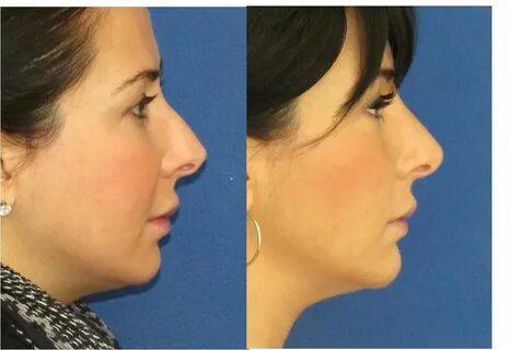 non-surgical nose job and chin augmentation with filler (Rad