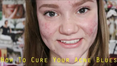 My Acne Story: How To Cope! StyleByAmber - YouTube