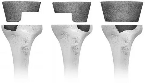 TKA Revision - Recon - Orthobullets