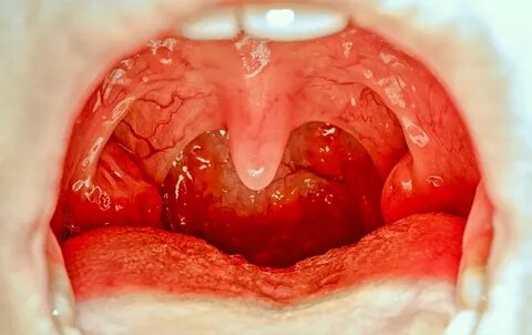 Tonsillectomy Adenoidectomy Dr S Md Siddique Youtube