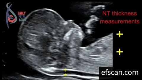 Nuchal translucency (NT) thickness measurement: for Early Fe