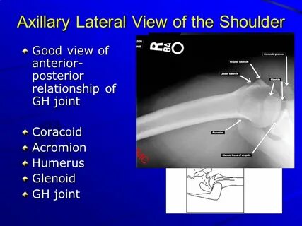 X-Ray Rounds: (Plain) Radiographic Evaluation of the Shoulde