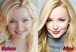 Dove Cameron Plastic Surgery Before and After Plastic surger