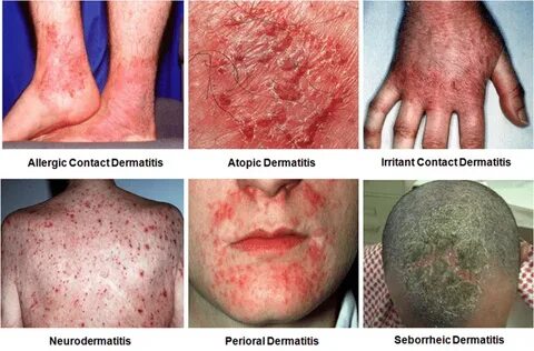 Atopic dermatitis (eczema) Diagnosis Archives - homeopathy36