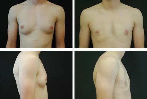 Transgender Female to Male Chest Surgery - Case 01903 - The 