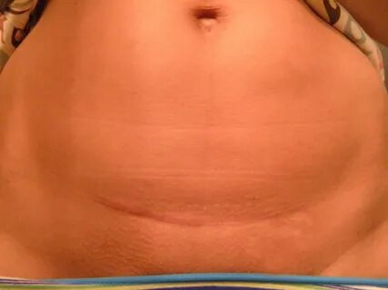 C Section Scar After One Year. Csection Scar 1 Year Later