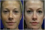 BBL Photofacial Skin Rejuvenation at PYNCH - Anti-Aging & Me