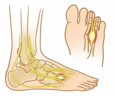 Насколько болезненна неврома Мортона? - Невролог-мед