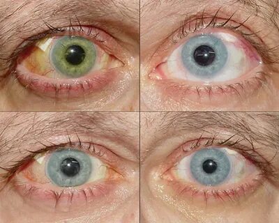 Iris colour change after glaucoma surgery associated with ha