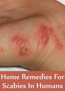 10 Home Remedies For Scabies In Humans - Natural Treatments 