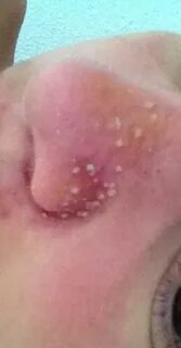 Was sind das für "Pickel" auf meiner Nase (Beauty)